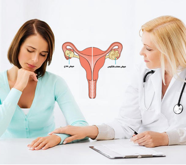 Research on the ultimate treatment of PCOS Syndrome