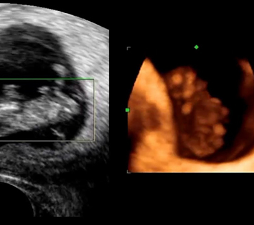 Four-dimensional sonar and Pregnancy